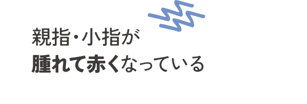 親指・小指が腫れて赤くなっている