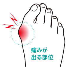 痛みが出る部位