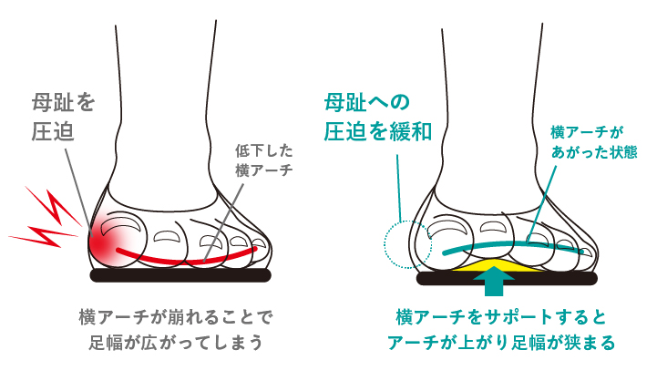 横アーチをサポートするとアーチが上がり足幅が狭まる