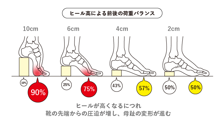 ヒールが高くなるにつれ靴の先端からの圧迫が増し、母趾の変形が進む