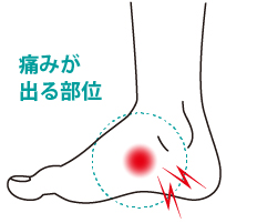 痛みが出る部位