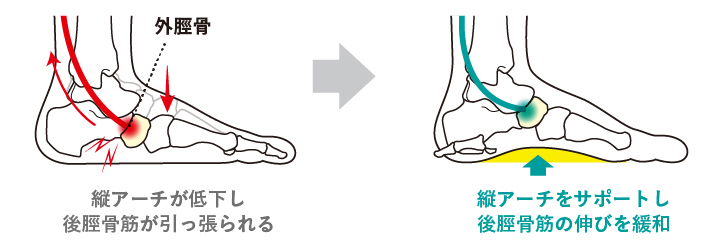 縦アーチをサポートし後脛骨筋の伸びを緩和