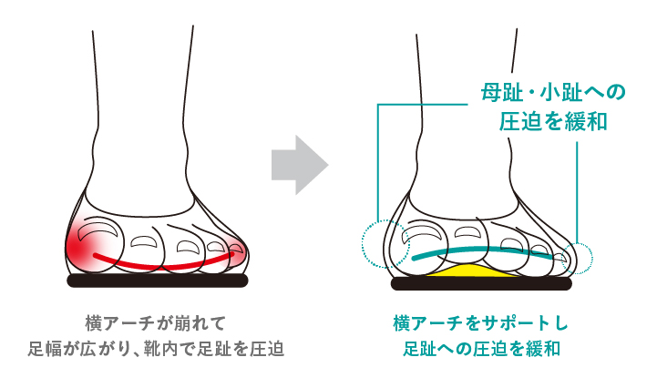 横アーチをサポートし足趾への圧迫を緩和