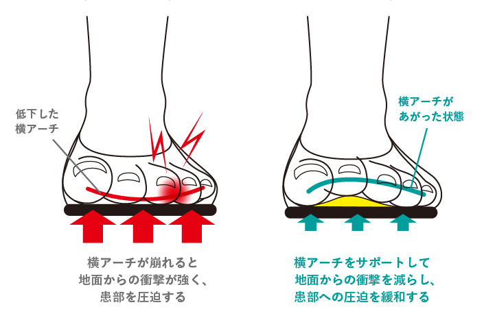 横アーチをサポートして地面からの衝撃を減らし、患部への圧迫を緩和する