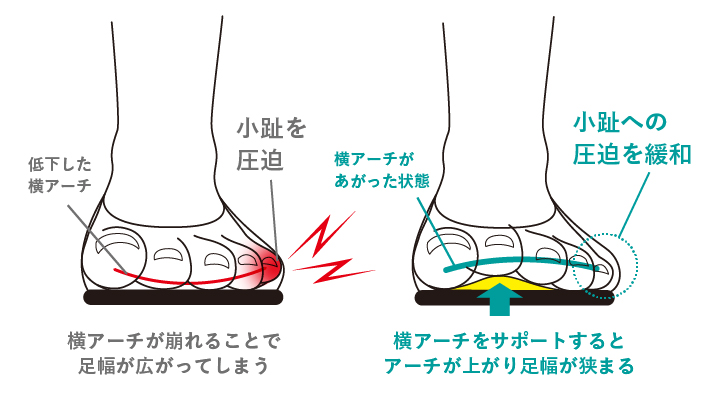 横アーチをサポートするとアーチが上がり足幅が狭まる