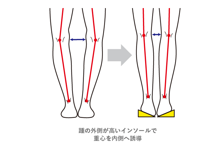 踵の外側が高いインソールで重心を内側へ誘導