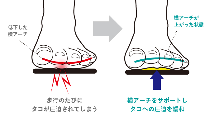 横アーチをサポートしタコへの圧迫を緩和